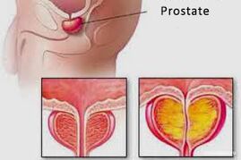 prostatë