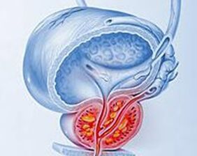 inflamacioni i prostatës me prostatit
