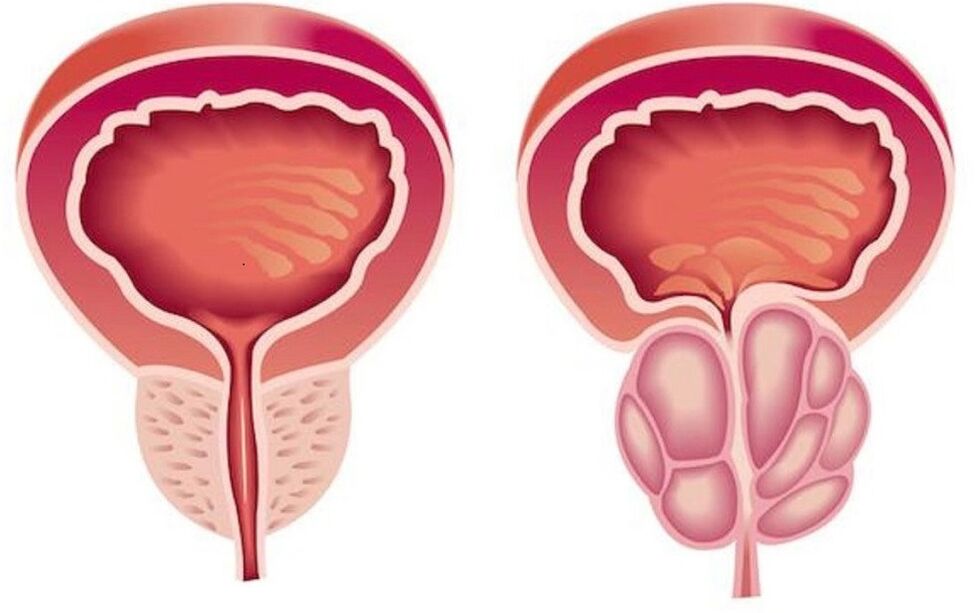 prostata e shëndetshme dhe e përflakur me prostatit